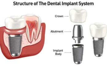 Dental Implants