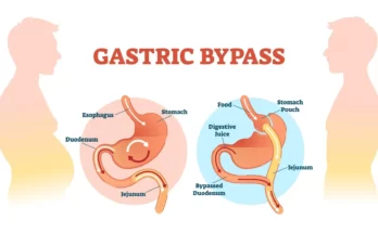 Gastric Bypass Surgery